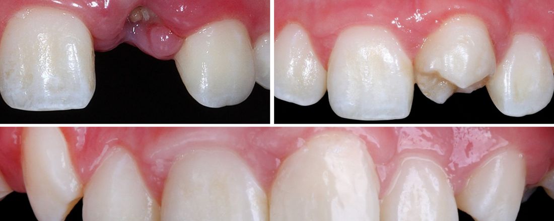 Soluções para perdas dentárias anteriores em crianças e adolescentes