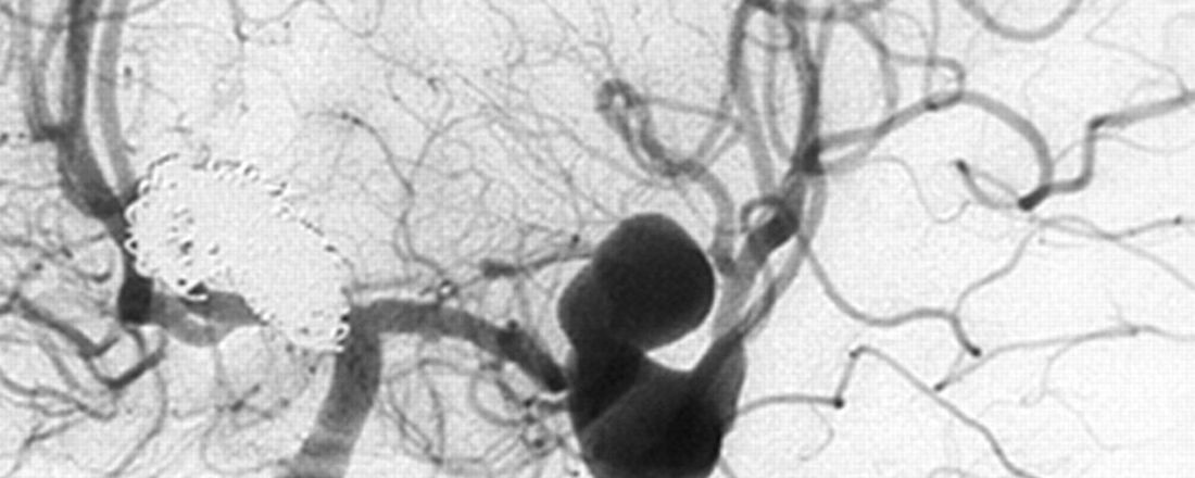 Tratamento endovascular do aneurisma cerebral