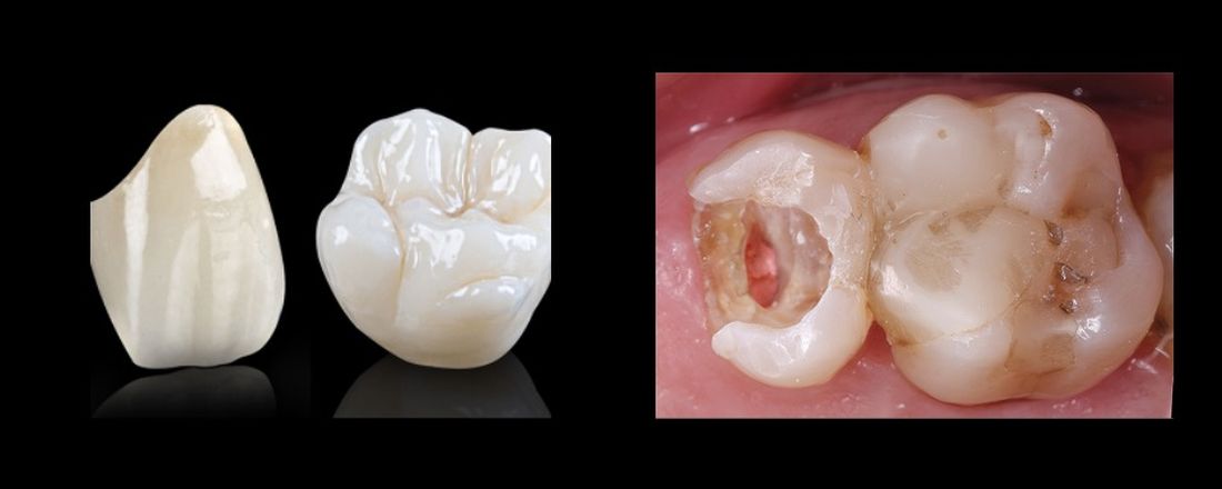 IMERSÃO CLÍNICA DENTES TRATADOS ENDODONTICAMENTE E COROAS METAL FREE