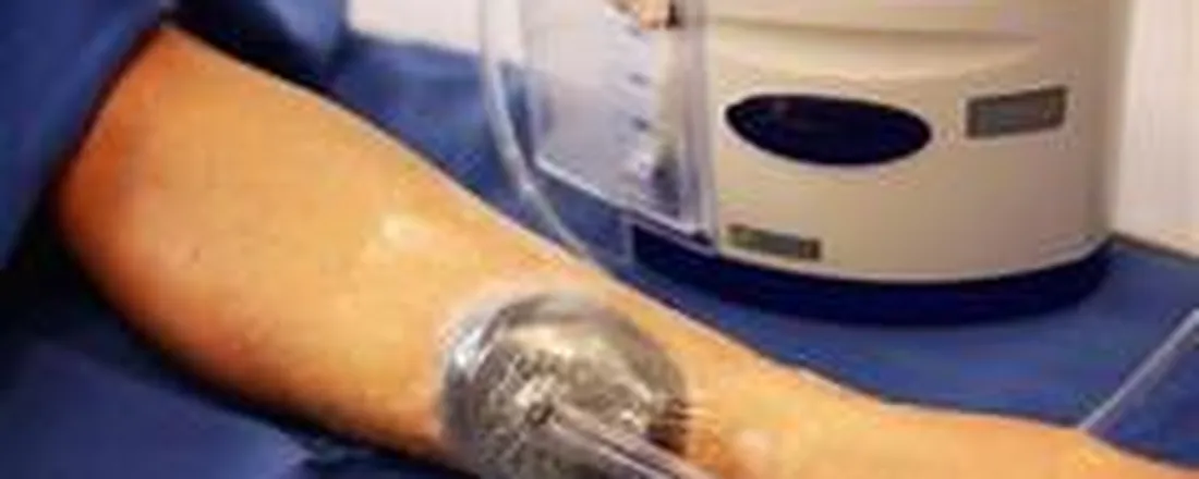 Curso de Terapia por Pressão Negativa - inovações terapêuticas no tratamento de feridas complexas
