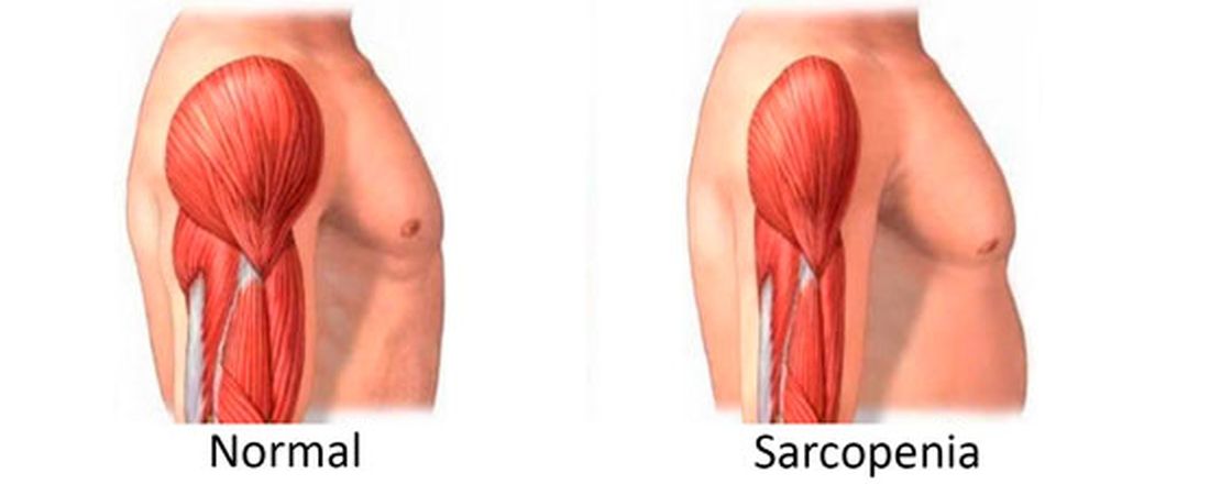 SARCOPENIA: DIAGNÓSTICO, PREVENÇÃO E CONDUTA NUTRICIONAL