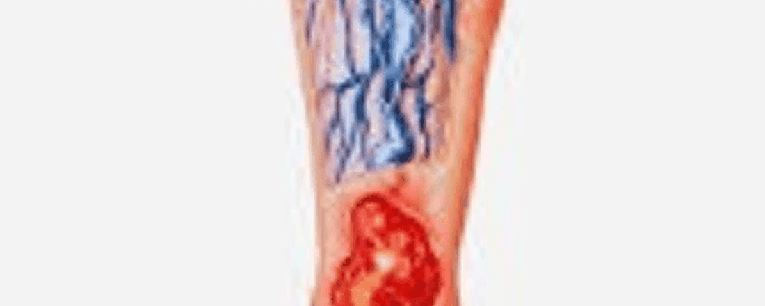Ulcera de perna