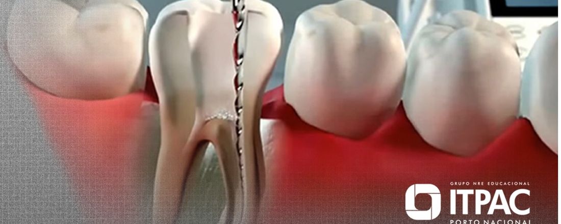 Instrumentação Mecanizada em Endodontia