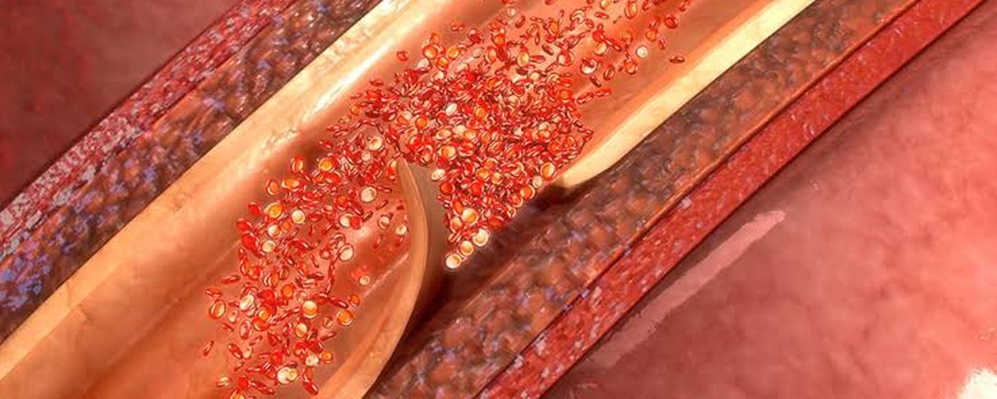 Quarta Científica Dissecção de Aorta