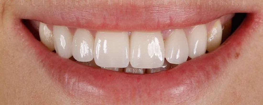Dentes brilhantes para o Carnaval!