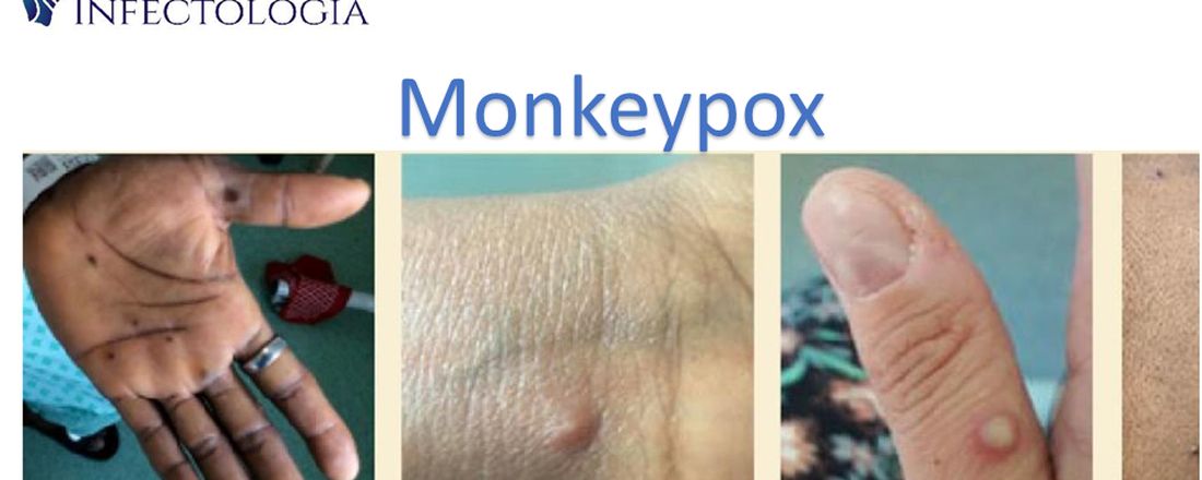 Monkeypox: da clínica ao diagnóstico